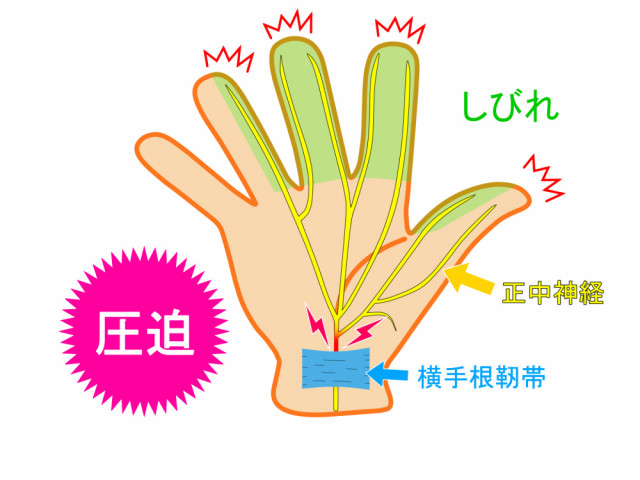 手根管のイラスト